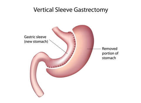 Gastric Sleeve Long Term Weight Loss