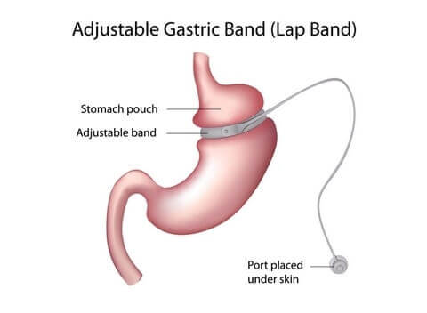 Band Around Stomach To Loss Weight
