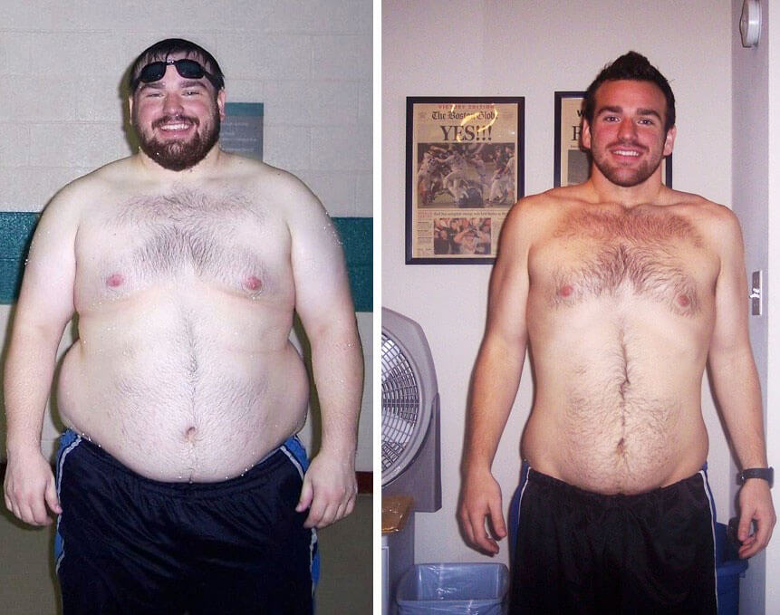 men before and after tummy tuck after gastric bypass