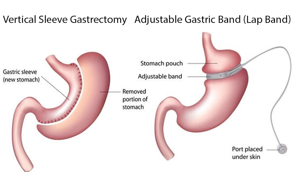 Gastric Sleeve Vs Lap-Band 