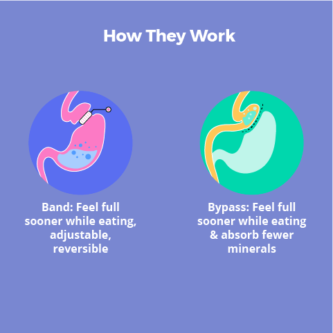 LAP-BAND® Vs Gastric Bypass - All You Need to Know - Bariatric Surgery ...