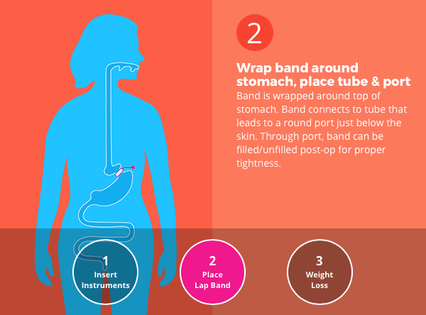 Requirement for lap band surgery