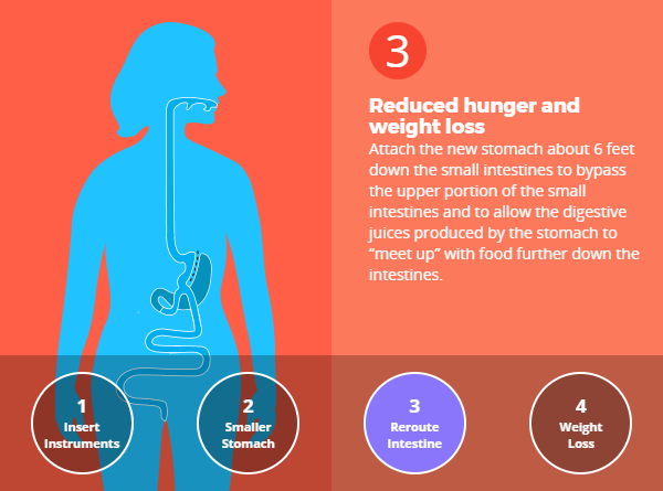 Mini Gastric Bypass Surgery 14 Ways It Will Affect You